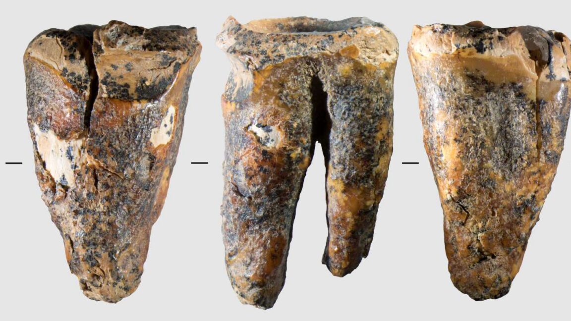 Dünyanın İlk Diş Hekimleri: Neandertaller 59 Bin Yıl Önce Diş Tedavisi Uyguladı