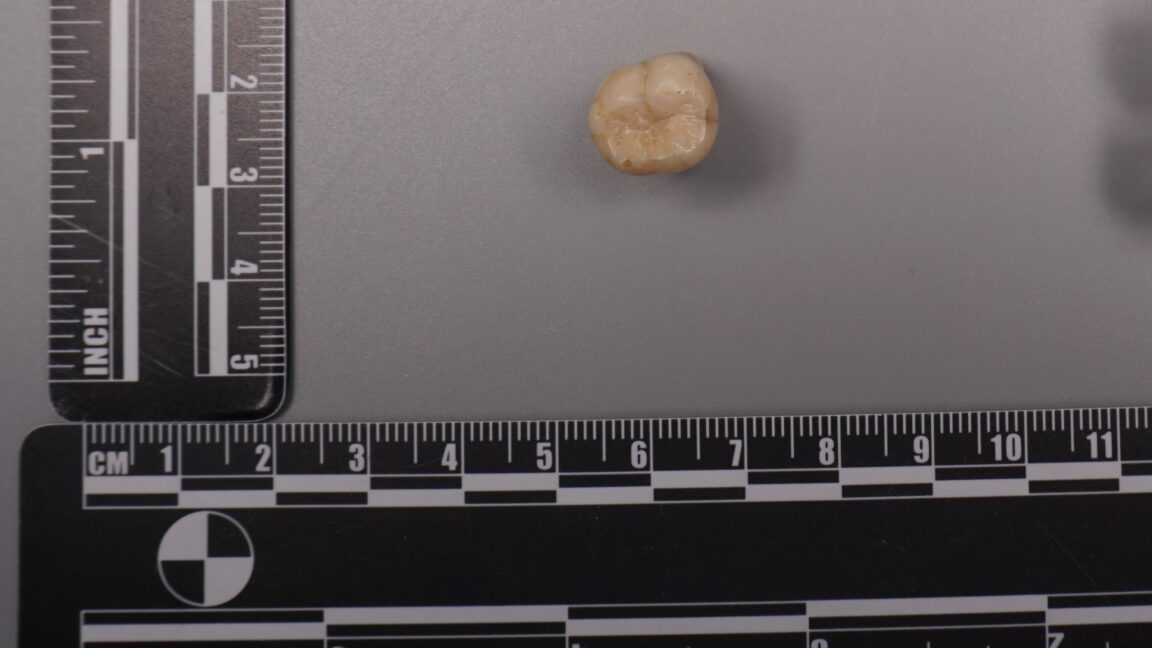 Homo erectus Dişlerindeki Proteinler, Denisovalıların Bize DNA Aktardığını Gösteriyor